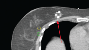 CT View of the BioZorb marker in extreme medial location: a challenging position to target the AccuBoost dose.