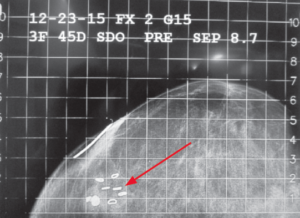 C-C image of the same patient with AccuBoost targeting coordinates identified and applicator marked.